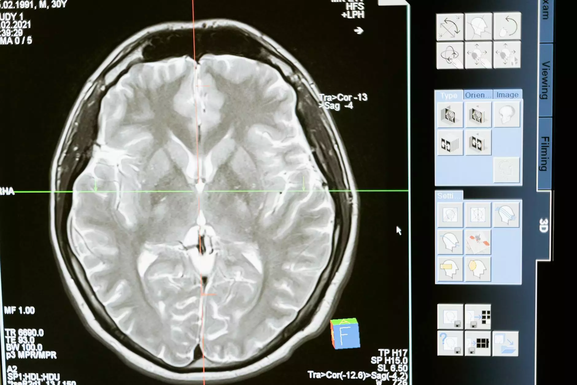 Sulcal Effacement - Understanding the Meaning and Implications ...